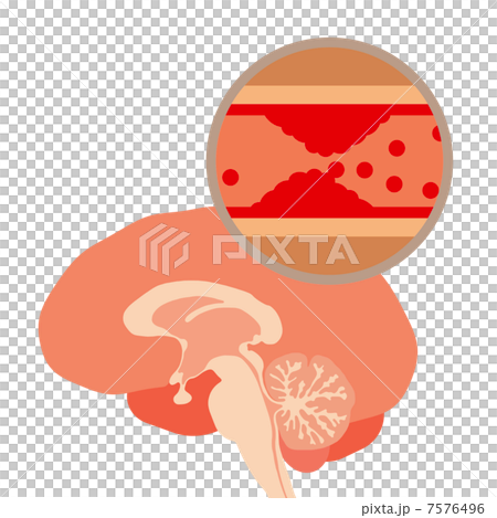 腦梗塞的風險 7576496