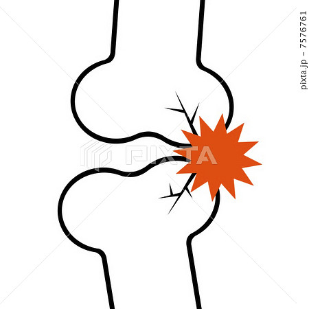 骨折のイラスト素材 骨折のイラスト素材