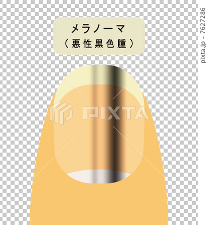爪に出来たメラノーマ 7627286