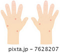 虫さされの手 7628207
