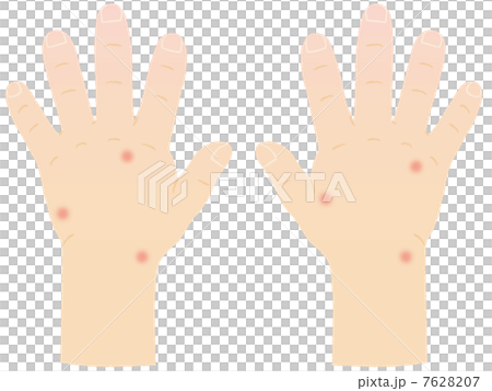 昆蟲咬手 7628207