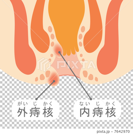 痔核（いぼ痔） 7642970