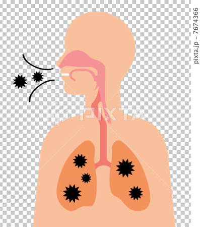空氣感染 空氣感染 7674366