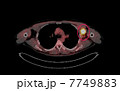 悪性リンパ腫のＰＥＴ／ＣＴ写真 7749883