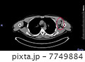 悪性リンパ腫のＰＥＴ／ＣＴ写真 7749884