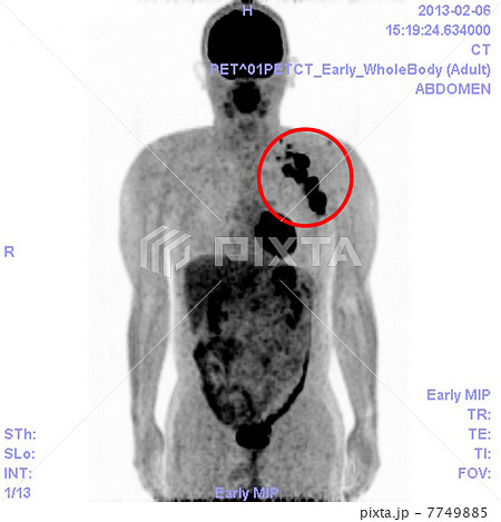 悪性リンパ腫のｐｅｔ ｃｔ写真の写真素材