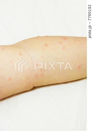 手足口病 7760192