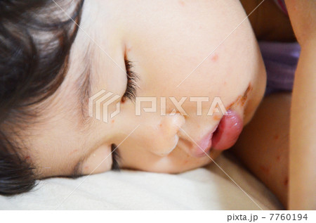 手足口病 7760194