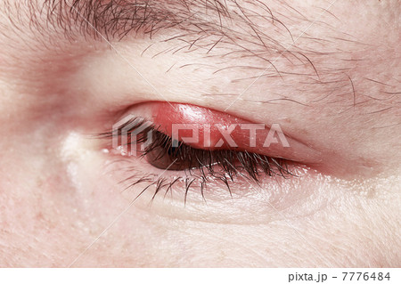 Sore Red Eye. Chalazion and Blepharitis. Inflammation 7776484
