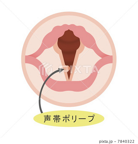 声帯ポリープ 7840322