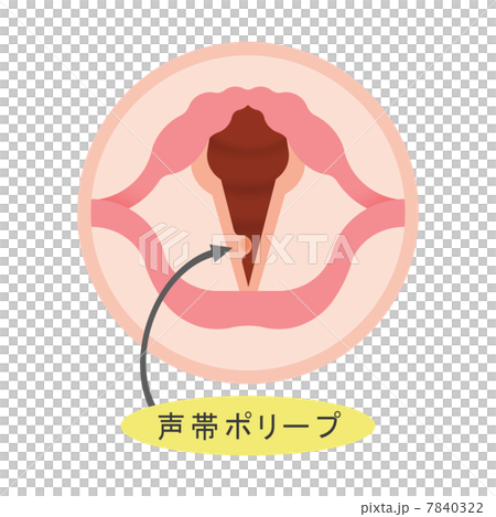 声帯ポリープ 7840322