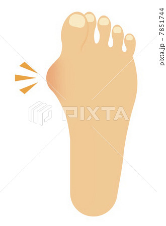 外反母趾 外反母趾 7851744