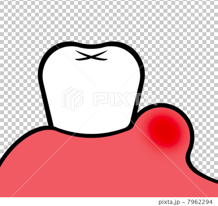 歯ぐきの腫れのイラスト素材