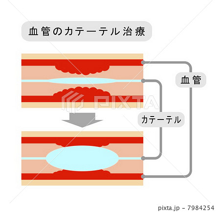 血管のカテーテル治療 血管のカテーテル治療 7984254