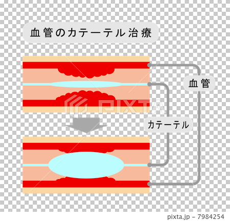 血管のカテーテル治療 血管のカテーテル治療 7984254