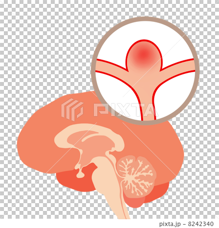 脳動脈瘤 8242340