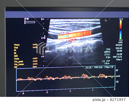 Vascular Ultrasound 8271957