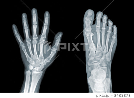 Roentgenogram 8435873