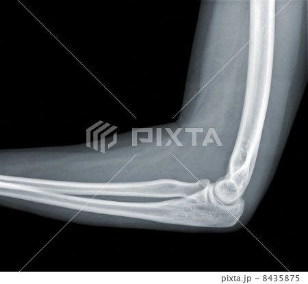X-ray view of elbow 8435875