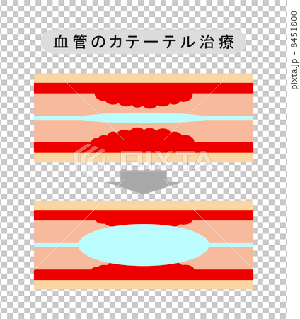 Catheterization of blood vessels Catheterization of blood vessels 8451800