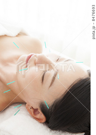 美容鍼 8476693