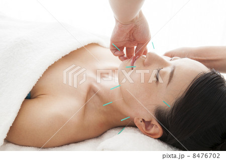 美容鍼 8476702