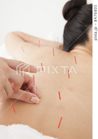 鍼治療 鍼治療 8476805