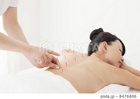 鍼治療　 8476806