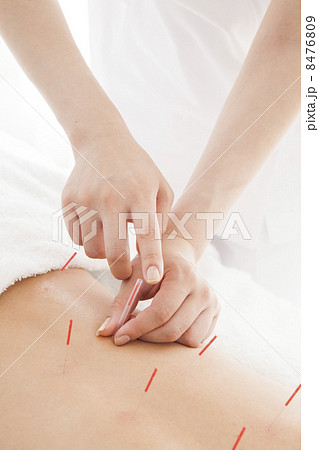 鍼治療　 8476809
