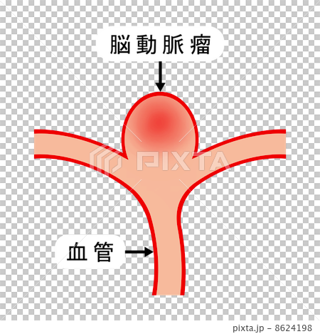 脳動脈瘤のイラスト素材