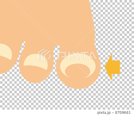 傷口釘 傷口釘 8709681