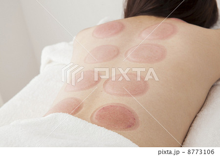 吸玉療法 8773106