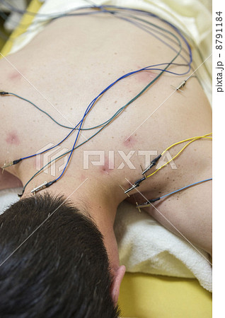 針治療 針治療 8791184