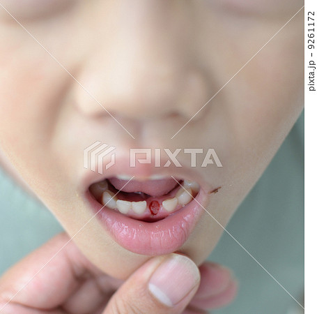 Loss milk tooth Loss milk tooth 9261172