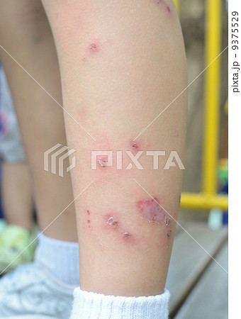 allergic dermatitis allergic dermatitis 9375529