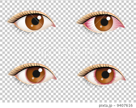 充血した目 9407616