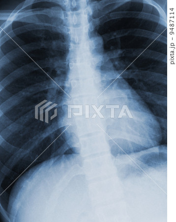 Chest xray scan Chest xray scan 9487114