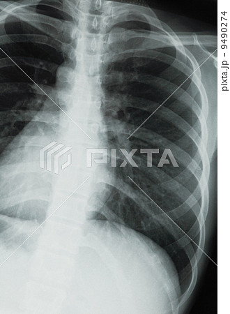 chest xray scan chest xray scan 9490274