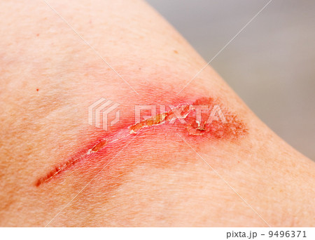 Burn Scar 9496371