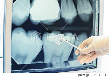 Hand in glove showing on teeth x-ray 9501201