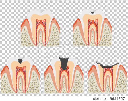 Caries Caries 9681267