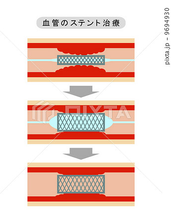 血管のステント治療のイラスト素材