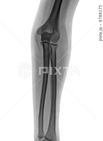 Elbow X-ray negative 9788175