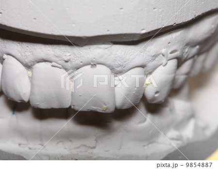 Dental gypsum model mould of teeth in plaster 9854887