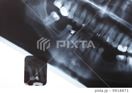 X-ray scan of humans teeth 9918871