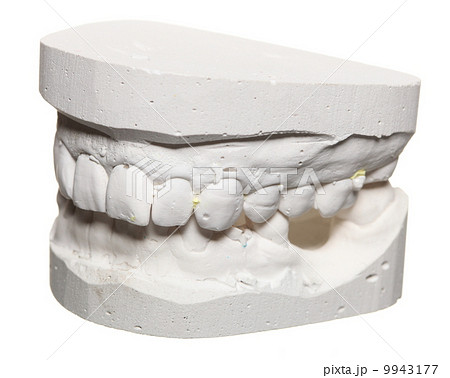 Dental gypsum model mould of teeth in plaster 9943177