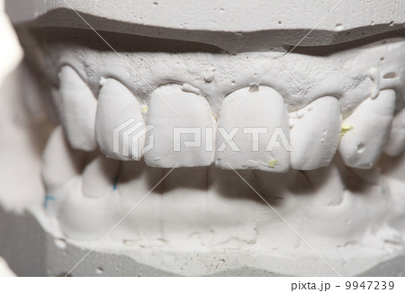Dental gypsum model mould of teeth in plaster 9947239