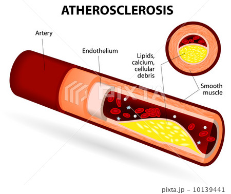 Atherosclerosis 10139441