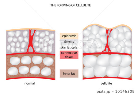 forming cellulite forming cellulite 10146309