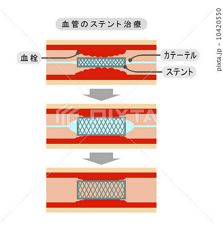 血管のステント治療 10420550